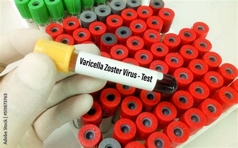 varicella blood test bottle|Varicella.